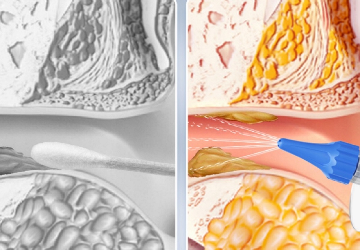 Kvalitná pomôcka na čistenie uší